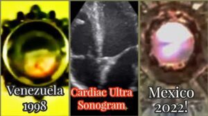 Cardiac Sonogram Reveals Human Beating Heart in 2 Eucharistic Miracles: Venezuela 1998 & Mexico 2022