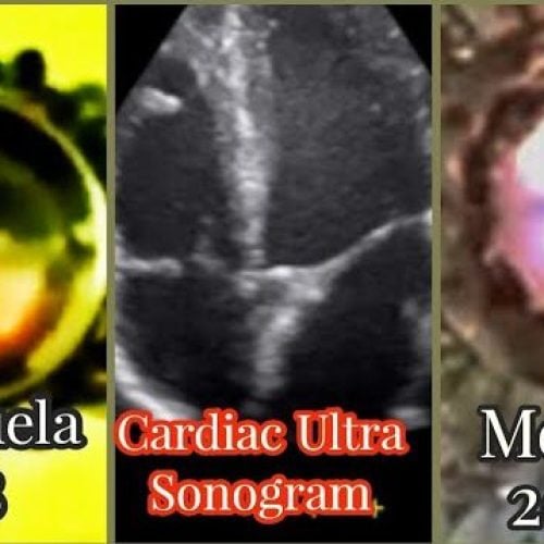 Cardiac Sonogram Reveals Human Beating Heart in 2 Eucharistic Miracles: Venezuela 1998 & Mexico 2022